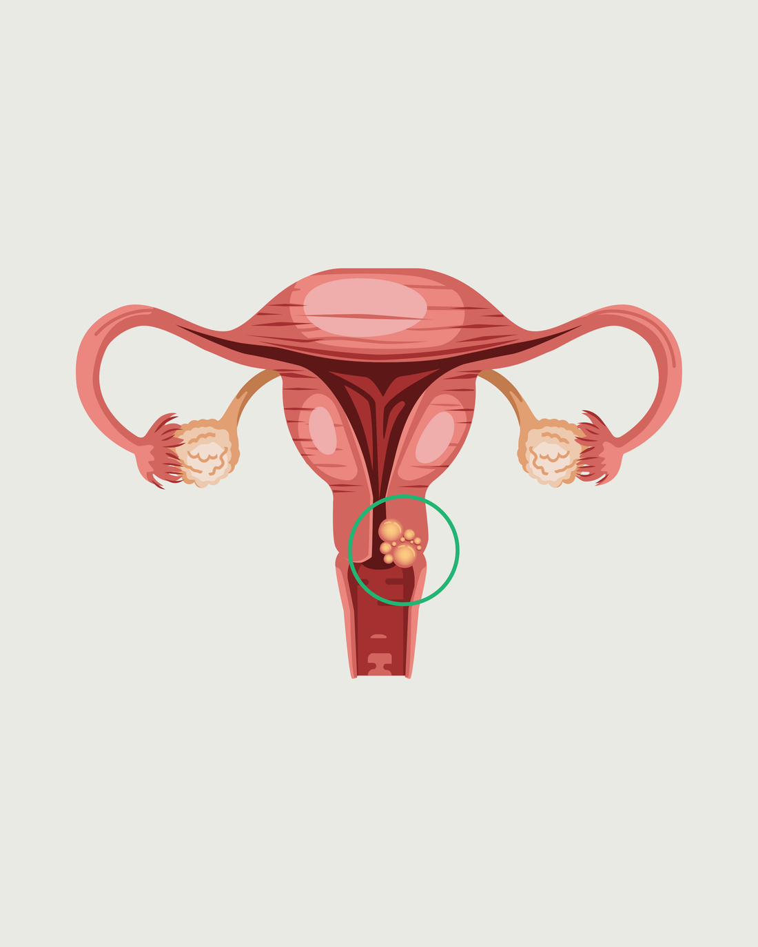 Every 2 Minutes a Woman Dies from Cervical Cancer